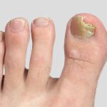 fungal-toe-nail