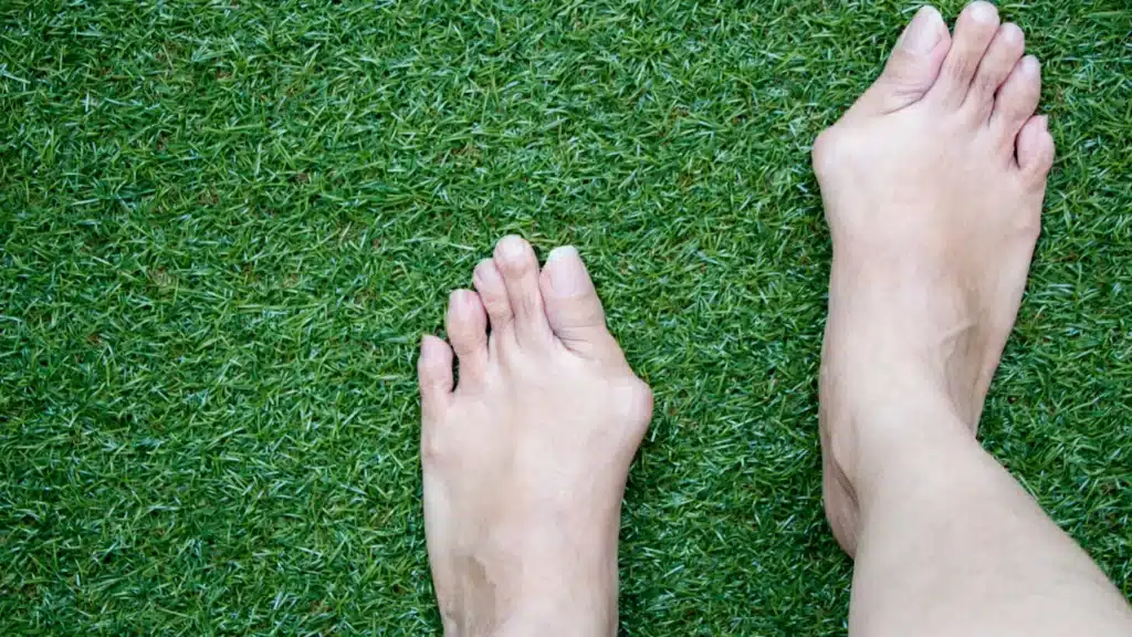 Bunions and Hammertoes treatment