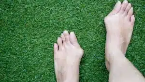 Bunions and Hammertoes treatment