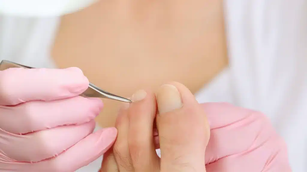 Professional Treatment for Corns and Calluses