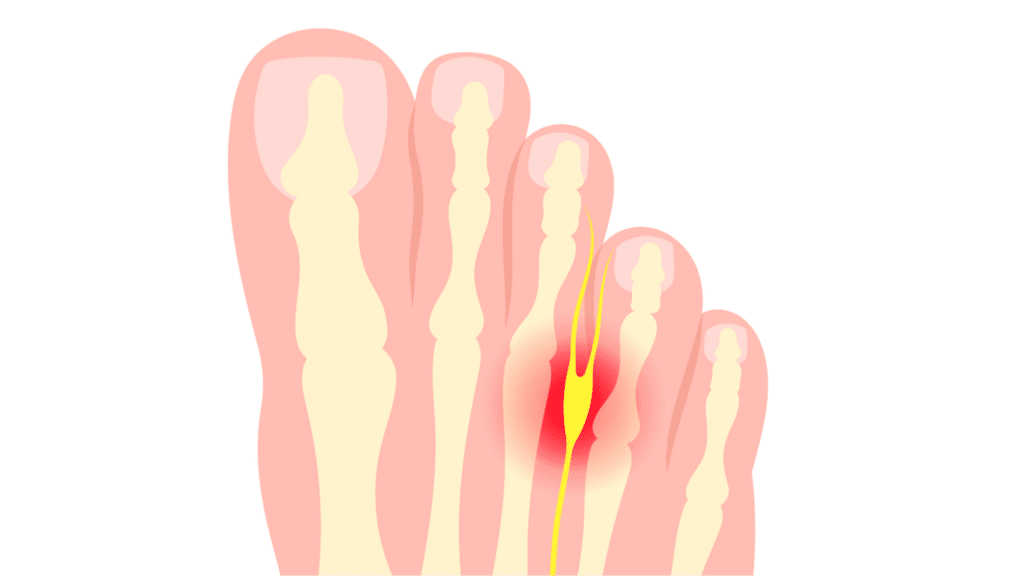 Morton’s Neuroma