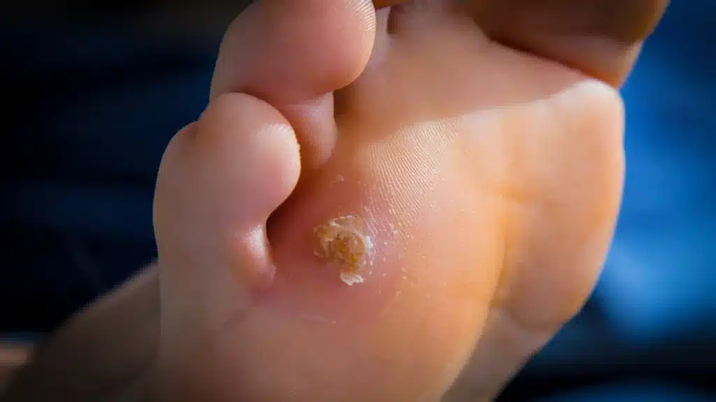 Causes of Corns and Calluses