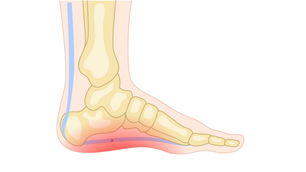 Plantar Fasciitis