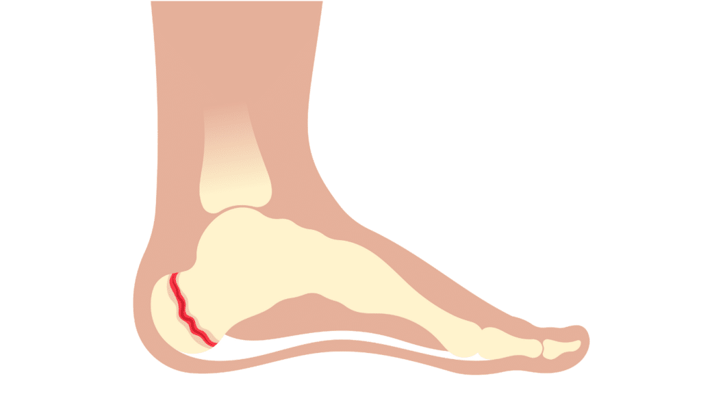 Heel Pain