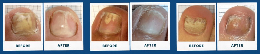 Toenail Fungus Treatment in Bayview