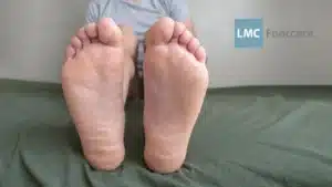Custom Orthotics for Flat Feet