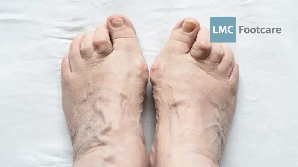Orthotics for Hammer Toes